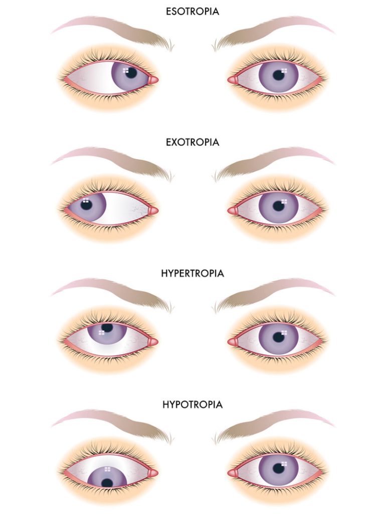 Strabismus Types