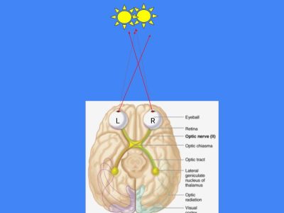 Vision Correction Diagram