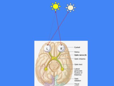 Vision Problem Diagram